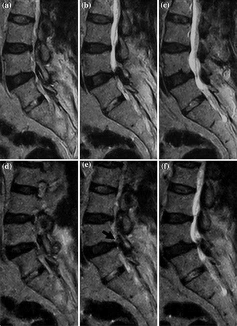 Synovial Cysts. Surgical Removal | Radiology Key