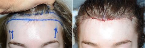 Forehead Reduction Surgery photos | Miami, FL | Patient120285