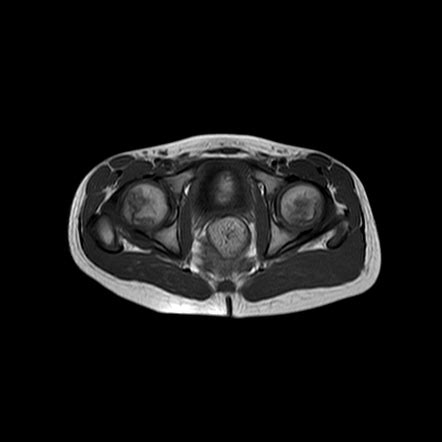 Transient Synovitis