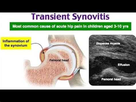 Transient synovitis - Cause, Symptoms, Treatment - Mobile Physio