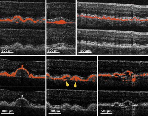 Examples of macular drusen characteristics. Each image consists of 2 ...