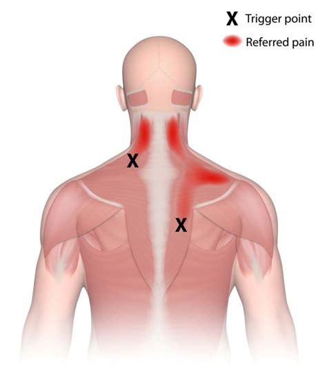 Neck & Upper Back Pain: How to Relieve Trapezius Pain