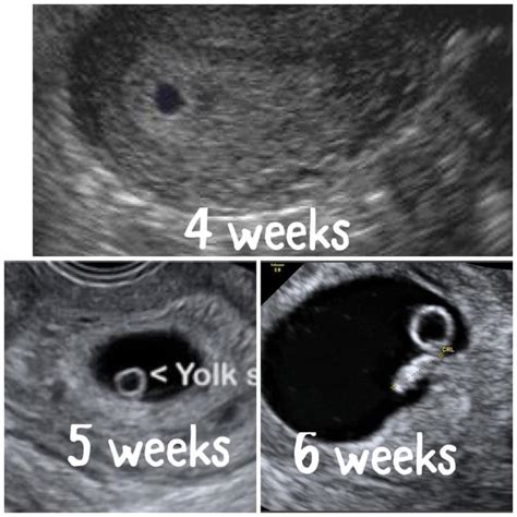 ?Early Scans From Ultrasound Direct Northern Ireland, 56% OFF