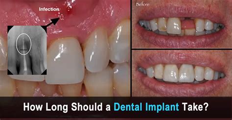 (Answered) How Long is a Dental Implant Procedure? | Dr. Saylor