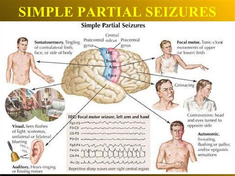 Epilepsy.ppt