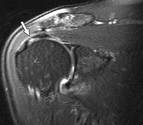 Torn rotator cuff mri image