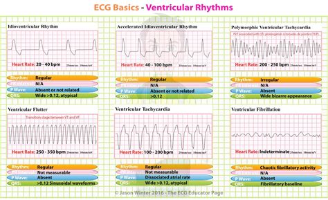 ECG Basics - Ventricular Rhythms #Cardiology #MedStudent ... | GrepMed