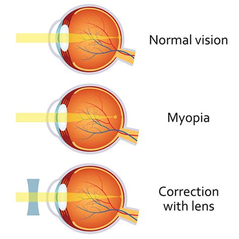 What is Nearsighted? | FramesDirect.com