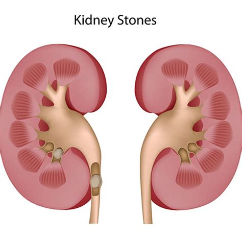 Management of Calculi (stones) in the Urinary Tract | West Coast Urology