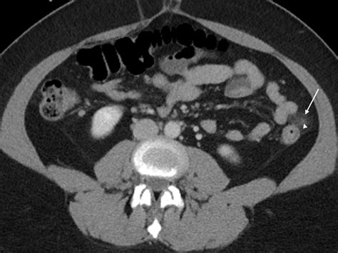 Epiploic Appendages