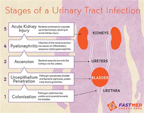 Can You Get A Kidney Infection Without A Uti - HealthyKidneyClub.com