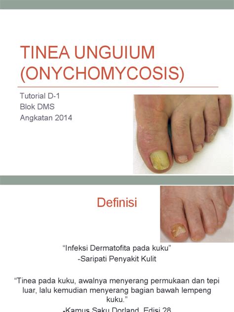 [DIAGRAM] Diagram Of Tinea Unguium - MYDIAGRAM.ONLINE