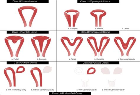 ESHRE/ESGE classification of uterine anomalies: schematic... | Download Scientific Diagram