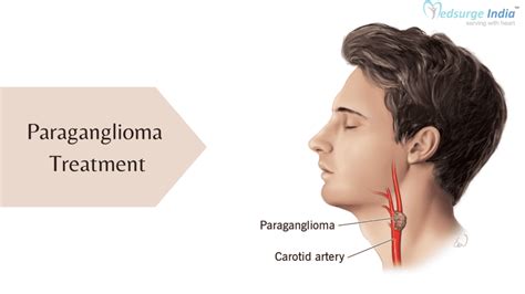 Paraganglioma Treatment Cost In India | Types & Procedure | Medsurge India