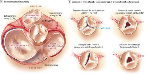 Asymptomatic Aortic Stenosis in the Elderly: A Clinical Review | Valvular Heart Disease | JAMA ...