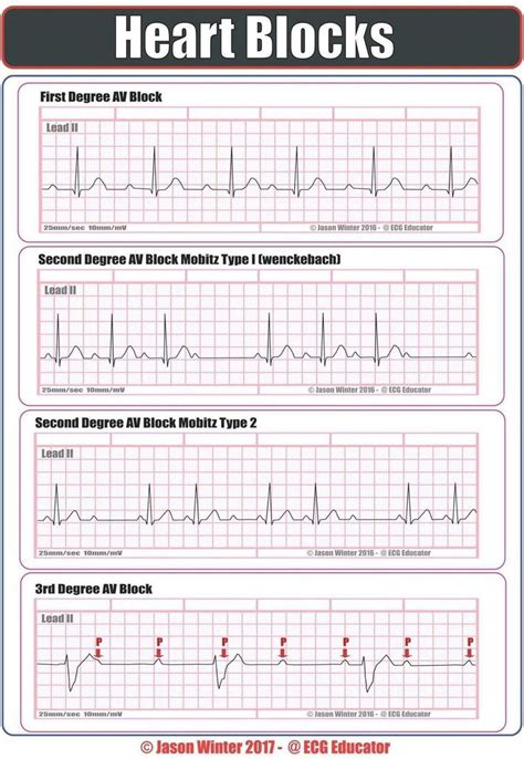 Pin by Samantha Bahantka on ekg | Cardiac nursing, Emergency nursing ...