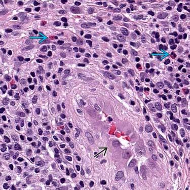 Angiolymphoid Hyperplasia With Eosinophilia | Basicmedical Key