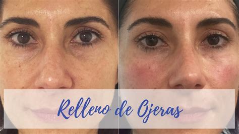 💉RELLENO de OJERAS con ÁCIDO HIALURÓNICO ️Antes y Después - YouTube