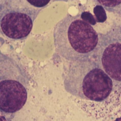 a, 4b-Clusters of plasma cells with azurophilic granules (MO-MGG, 100x ...