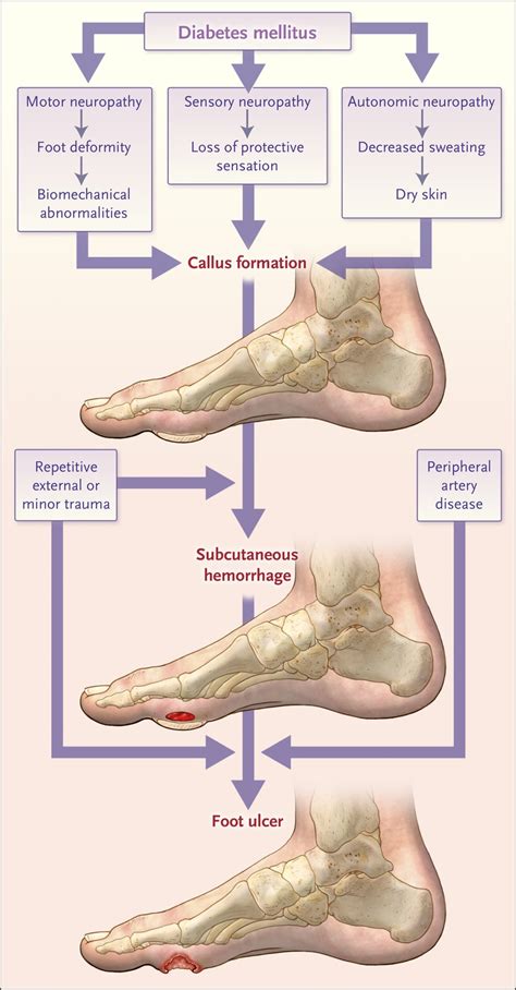 Diabetic Foot Ulcers and Their Recurrence | NEJM