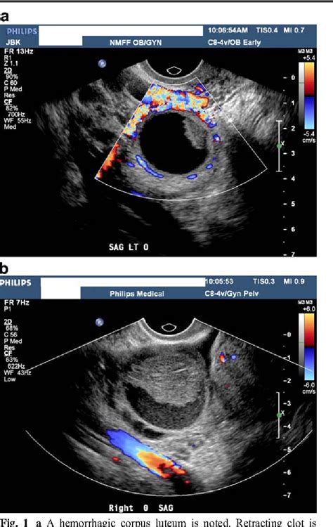 Transvaginal ultrasound assessment of the premenopausal ovarian mass | Semantic Scholar