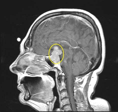 Pituitary Adenoma Ct Scan