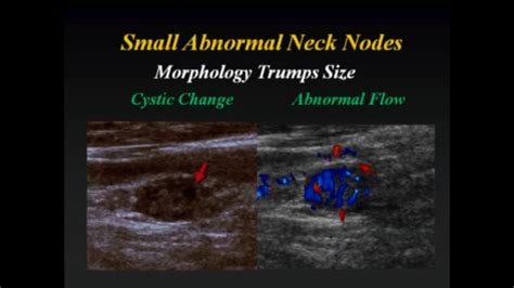 Cervical lymph nodes