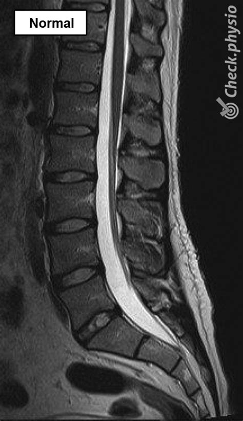 Lumbar spinal stenosis | Physio Check