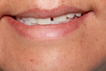 Periodontal Disease symptoms are often hidden in smokers, treatment is available at Surbiton ...