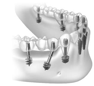 Frequently Asked Questions About Basal Implants, Including Benefits, Procedure, Cost and ...