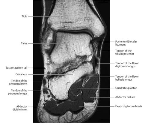 Foot Muscles Mri Anatomy - Foot, Ankle, and Calf | Musculoskeletal Key : If more detail is ...