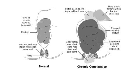 Fecal soiling (Encopresis), Kovai Kids Clinic | I Dr. Siva Bharathi MD(Pediatrcian) AB (USA ...