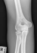 Elbow series (summary) | Radiology Reference Article | Radiopaedia.org