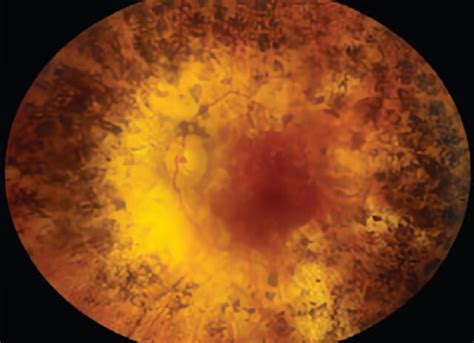 Retinitis Pigmentosa Treatment | Retinal Consultants Medical Group