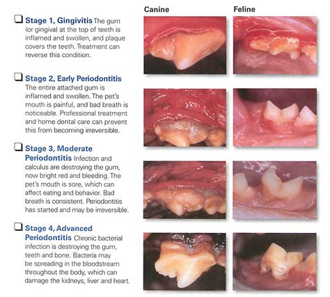 Here's What You Need to Know About the Stages of Periodontal Disease ...