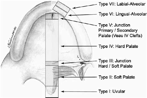 Figure 1 from The Rate of Oronasal Fistula following Primary Cleft Palate Surgery: A Meta ...