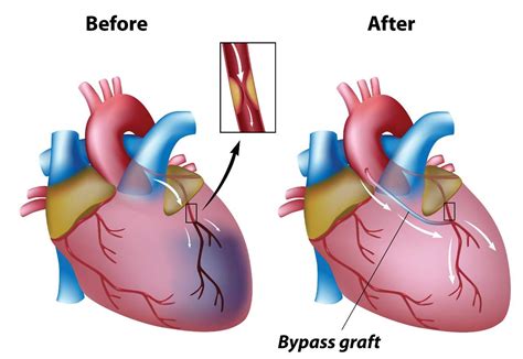 Coronary Artery Bypass Graft Surgery (CABG) - Cardiovascular Interventions Orlando