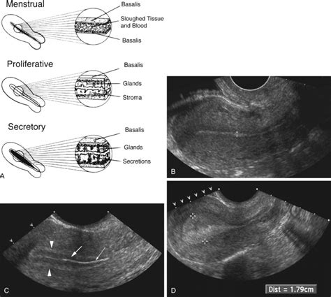 Ultrasound Evaluation of the Uterus | Radiology Key