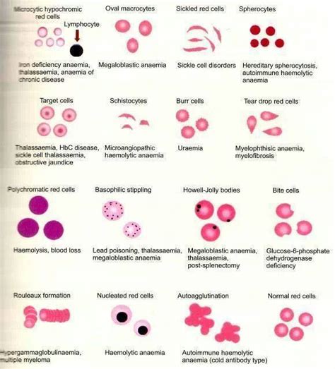 Red cell abnormalities | Medical Laboratories