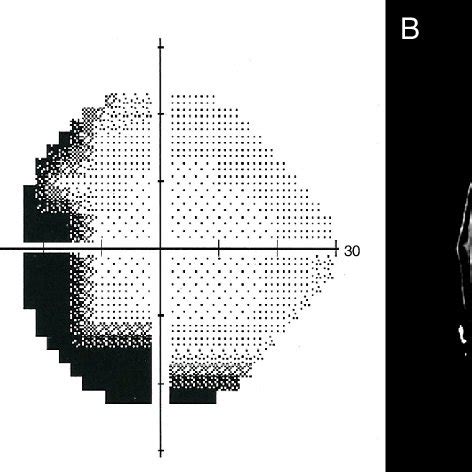 Schematic representation of the visual field in the visual cortex. | Download Scientific Diagram