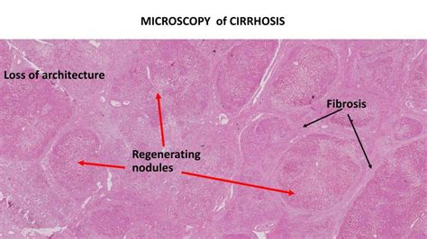 Liver Cirrhosis Histology