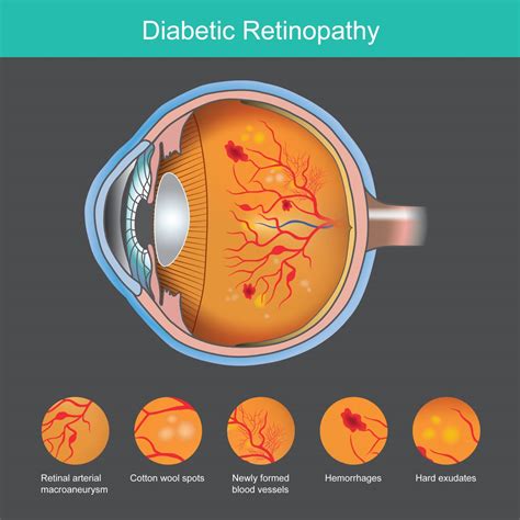 Eyenuk Announces FDA Clearance for EyeArt Autonomous AI System for Diabetic Retinopathy ...