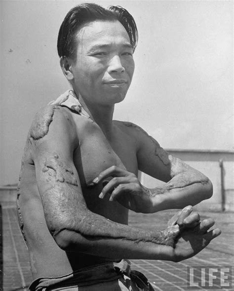 A survivor still hospitalized in Hiroshima showing arms and torso covered with keloids caused by ...