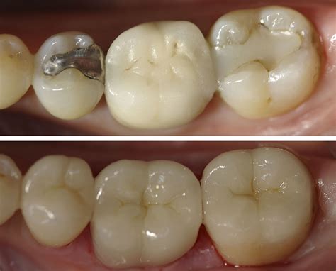 Before and After: Patient had two molars with old, broken, composite ...