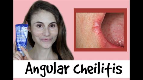 Angular cheilitis causes & treatments: a Q&A with dermatologist Dr Dray | Cracked corners of ...