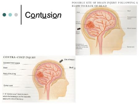 MOI, SIgns ans Symptoms - Cerebral cONTUSION