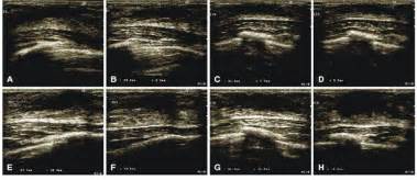 a–d Breast ultrasound scan showing bilateral gynecomastia in patient 1... | Download Scientific ...