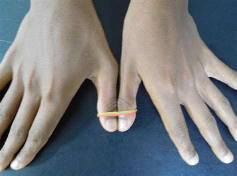 Simultaneous combined complete tear of radial and ulnar collateral ligaments of thumb in an ...