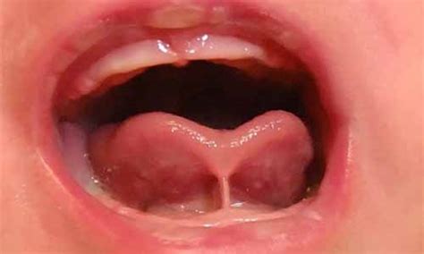 What is Posterior Tongue Tie and How to Know if Your Child Has it