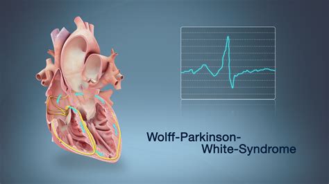 Wolff-Parkinson-White Syndrome Shown Using Medical Animation